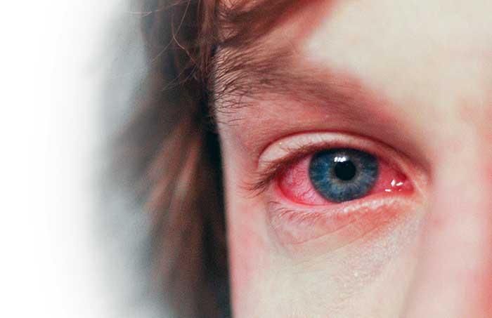 Allergia, vörös, viszkető, égő szemek